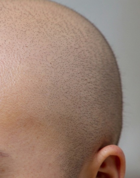 Client feeling confident after hair loss treatment at Obsidian Clinics Glasgow