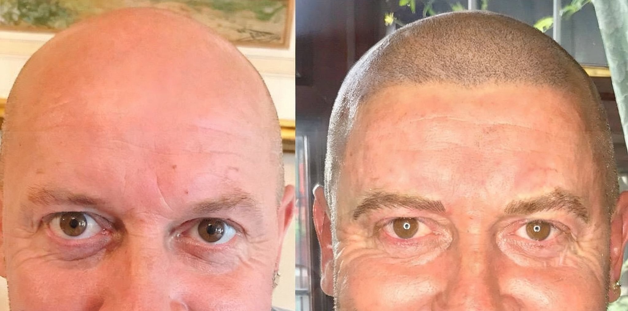 Scalp micropigmentation treatment at Obsidian Clinics Glasgow