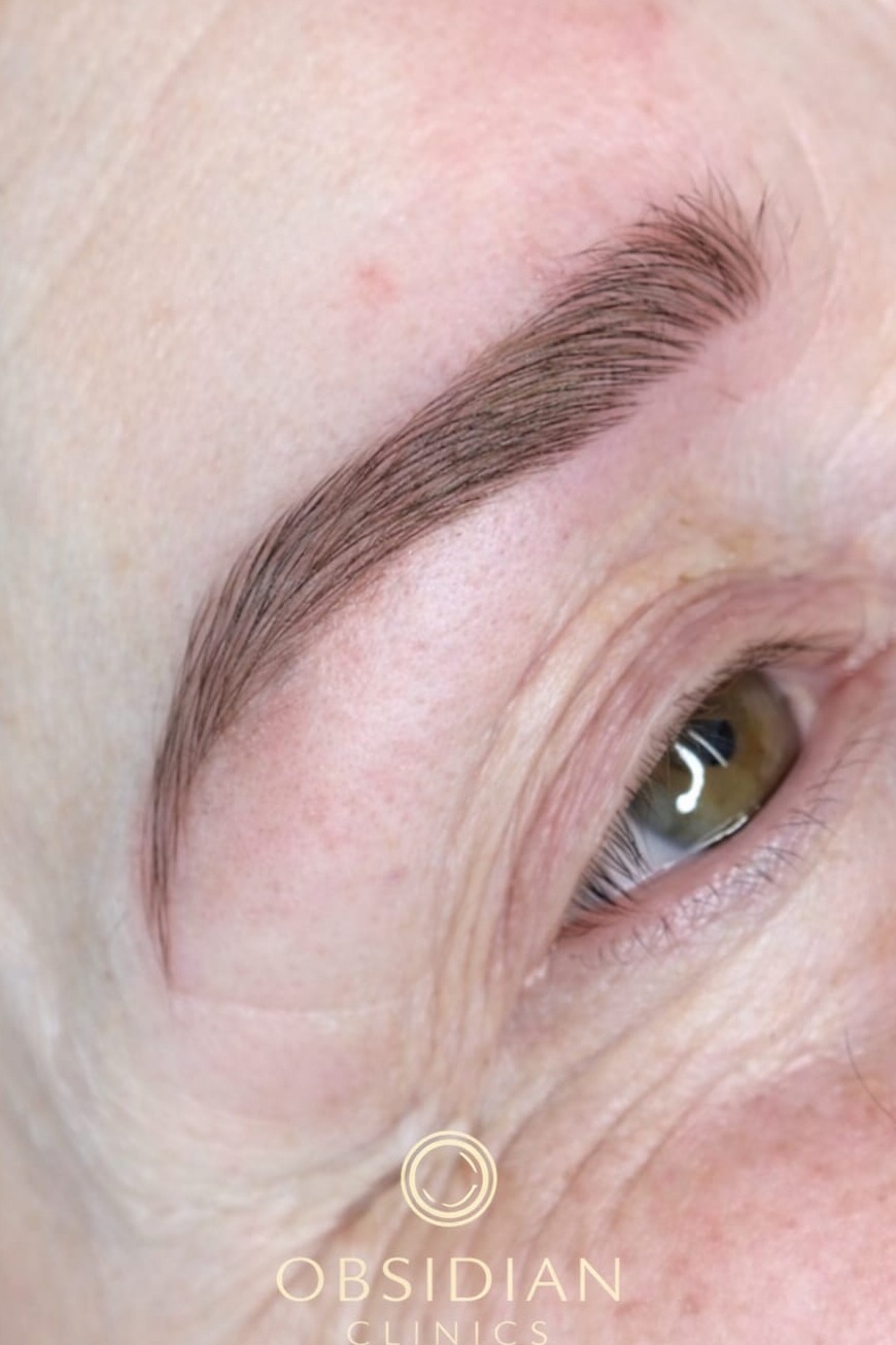 SPMU brows after remedial correction — healed result