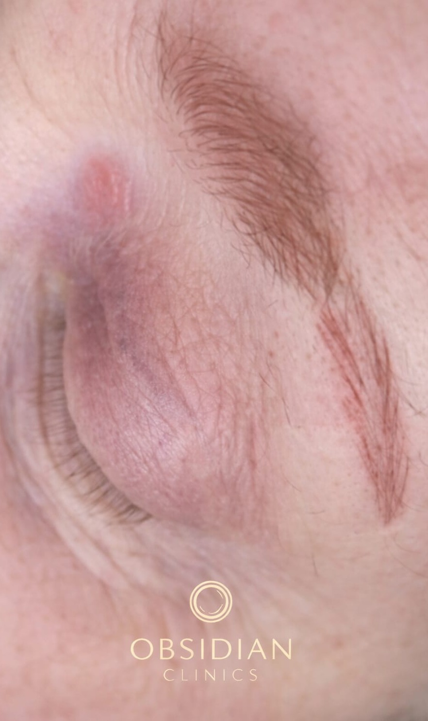 SPMU brows before remedial correction treatment