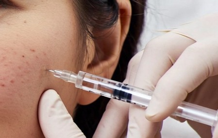 Anti-wrinkle injections Glasgow