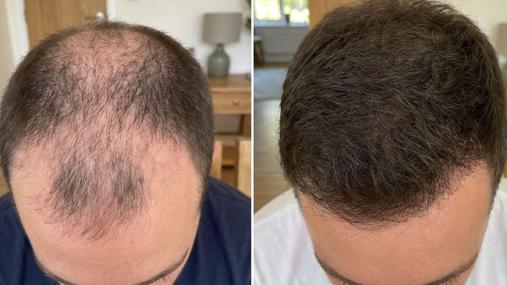 Confident man after scalp micropigmentation treatment
