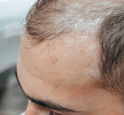 SMP and hair loss training course at Obsidian Institute